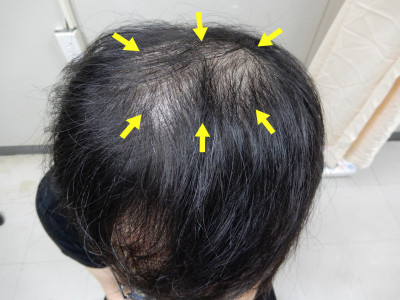 3旬男掉髮以為只是雄性禿  一查竟罹梅毒