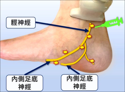 小腿骨折癒合 脛神經壓迫痛到腳底