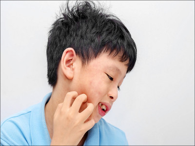 擦酒精治蕁麻疹？ 可別拖成慢性難治型