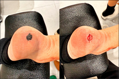 腳跟皮膚黑一塊 皮下血腫險當惡性腫瘤