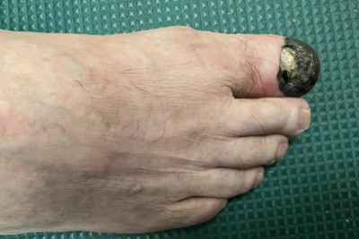 以為腳趾瘀青久治不癒竟罹癌 皮膚科醫師籲重視皮膚變化