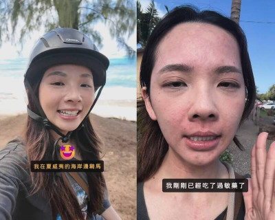 滴妹騎馬後竟嚴重過敏 醫談常見過敏原