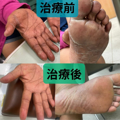癌友化療引來手腳紅腫痛 中醫調理幫擺脫不適