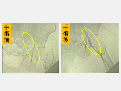 7旬婦左腿突腫脹 竟是髂靜脈壓迫症候群作祟