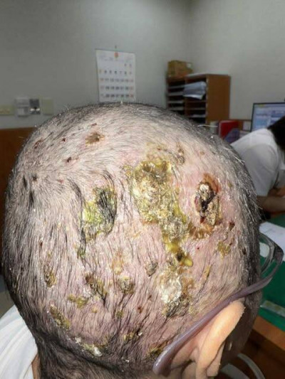 抗肺腺癌皮膚遭摧殘 林口長庚找到新解方登上國際期刋