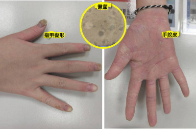 女孩指甲變形、脫皮很鬱卒 求醫10年才揪出元兇