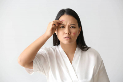 滿臉痘痘卻不能服A酸 光動力療法成功控制「爛痘」