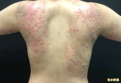 乾癬纏身! 剪頭髮遭推銷抗屑產品 創業老闆4年不敢進髮廊