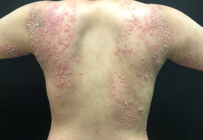 乾癬健保不友善？ 民團籲加速審核、放寬條件