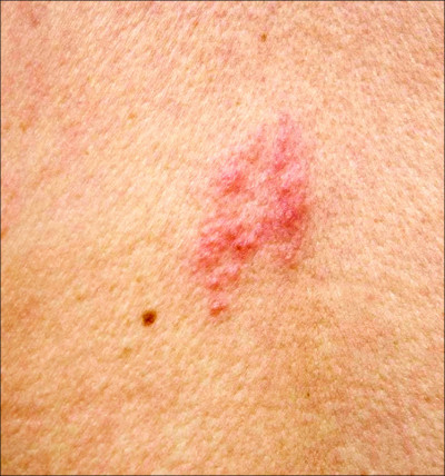 早期皮蛇無皮疹 易被誤認椎間盤突出