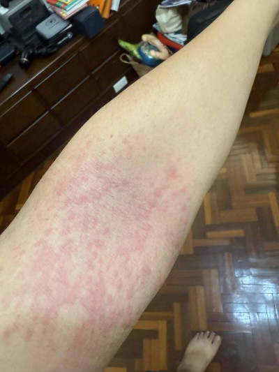 異位性皮膚炎上身 皮膚科醫：別笑連醫師也斷不了根