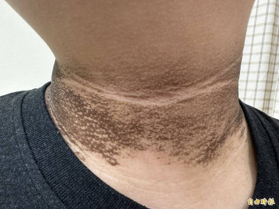 脖子黑≠沒洗乾淨 黑色棘皮症上身啦！