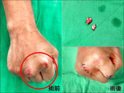 竹科男敲鍵盤卡卡 竟是痛風惡化長出「痛風石」