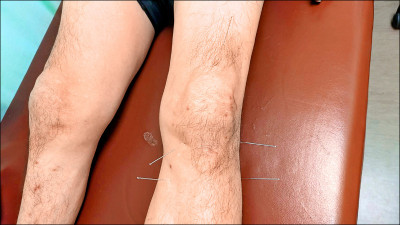 退化性關節炎 中醫助一臂之力