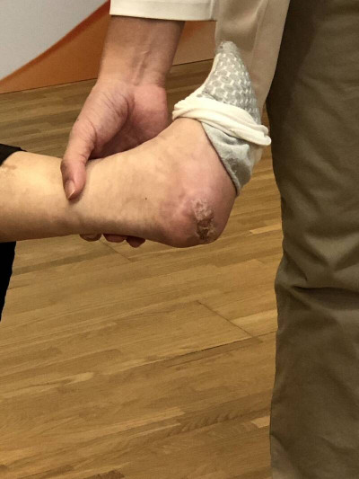 糖友足潰瘍如棒球大 幹細胞治療救回殘足免被截肢