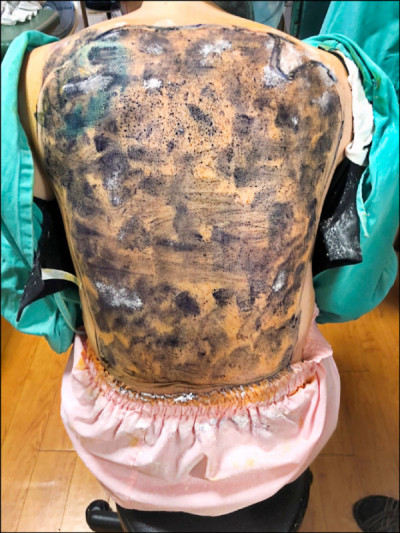 軍人「代償性出汗」暈倒 微波熱能治療不再「大缺水」