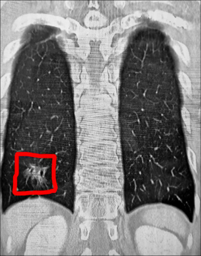 車禍肋骨斷 意外發現罹肺腺癌