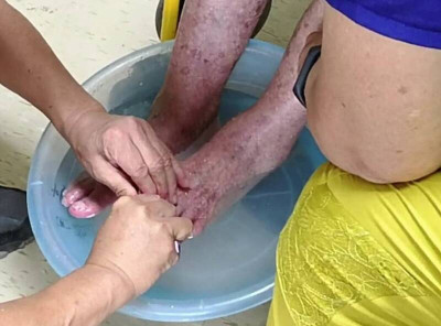 被足底疣糾纏 醫授便宜又好用泡腳法擺脫它