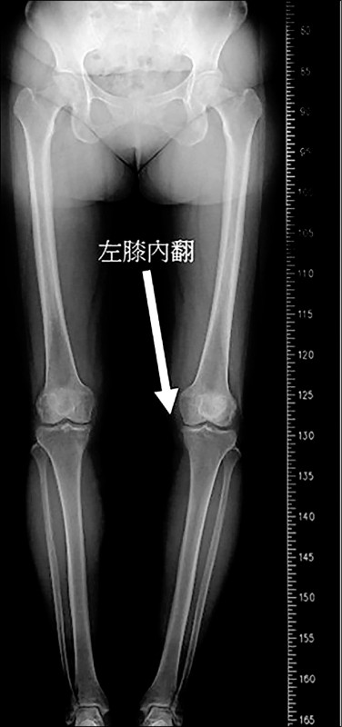 多重膝損傷 複合性手術標本兼治