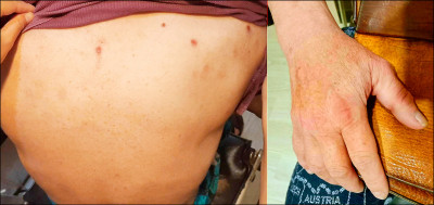 大叔耳鳴、皮膚發癢粗糙 賈伯斯症候群上身