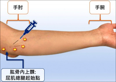 揮桿瞬間出現撕裂感 急性拉扯誘發高爾夫球肘