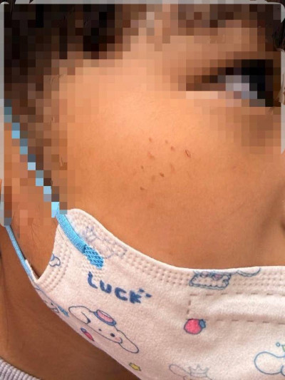 幼童臉部紅疹反覆擦藥 不是蚊蟲咬 醫抽絲找禍首