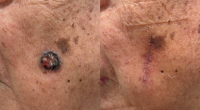 8旬翁臉上黑痣變大潰瘍 皮膚基底細胞癌上身