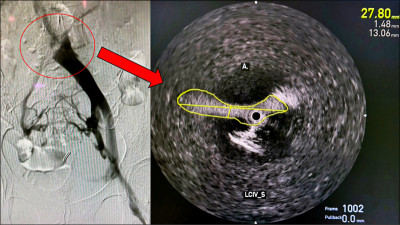 小腿反覆紅腫癢 靜脈壓力異常警訊