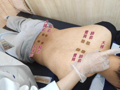 一到冬天就鼻塞？ 中醫「三九貼」調養體質有解  敷貼流程一次看