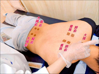 一到冬天就鼻塞？ 中醫「三九貼」可調養體質