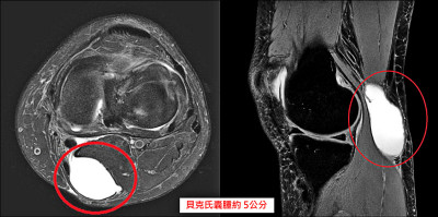 婦後膝窩長腫塊、蹲跪會麻 揪出「貝克氏囊腫」作怪