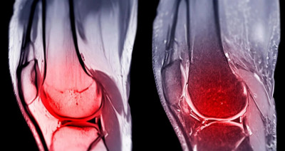 膝蓋退化免開刀！史丹福揭「1衰老酶」關鍵 1針讓軟骨自行再生