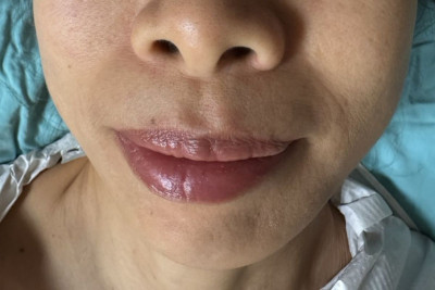 罕見腮腺癌影響臉部外觀 顏面切除修補手術找回自信