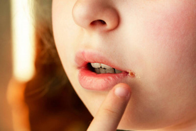 嘴角裂、腳跟裂、脖子變黑？  百萬網紅醫：多半不是缺營養