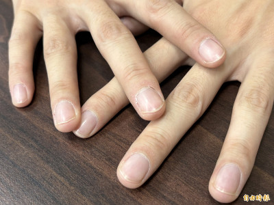 指甲「這層皮」別亂摳！ 恐讓黴菌入侵指甲根部