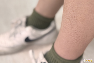 過年泡湯、熬夜、暴飲暴食&hellip;皮膚問題恐一次爆發