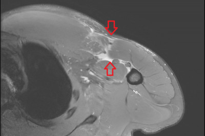 27歲民眾健身胸痛竟是肌腱斷裂  肌腱縫合手術重拾健康