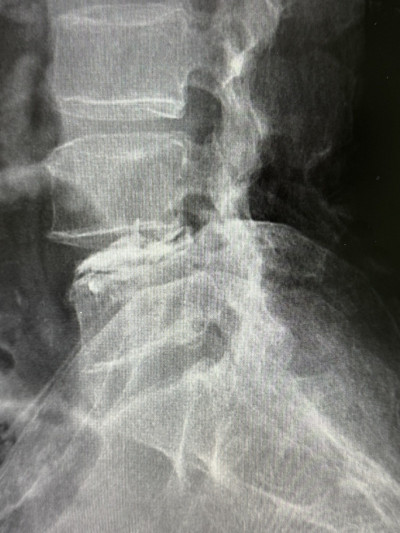 套針脊椎矯正手術 107歲人瑞阿嬤恢復日常活動