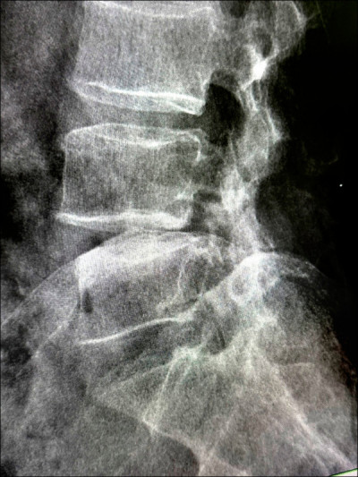 套針脊椎矯正手術 107歲人瑞嬤擺脫輪椅