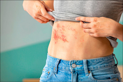 皮蛇恐添中風、心梗風險 30~49歲患者有增多趨勢