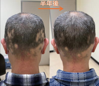 圓形禿反覆發作好崩潰 中醫師禍首是免疫失衡、慢性發炎