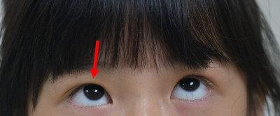 被同學膝蓋撞到！9歲女童眼球無法轉動 竟是眼窩骨折