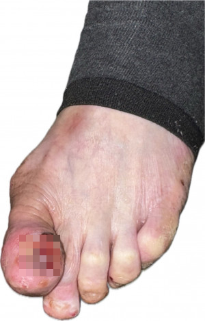 7旬婦甲溝化膿１年多仍治不好 竟是惡性黑色素癌