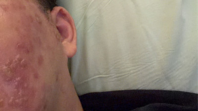 牙痛失眠3天引「蛇」出洞！帶狀皰疹發作 醫：恐失明失聰