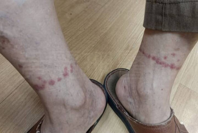 清明掃墓不只防蜱蟲 醫揭腳踝突冒「一圈紅疹」真相