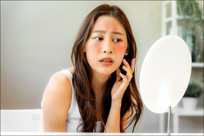 痘痘危機 不是青春期結束就沒事