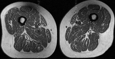 大腿像「牛排油花」 研究發現：這種飲食與肌肉變質有關