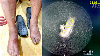 阿伯腳腫皮膚發黑 深層靜脈回流障礙警訊