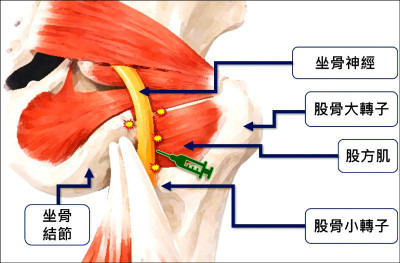 臀部疼痛無法久坐 可能是坐骨股骨夾擠症候群