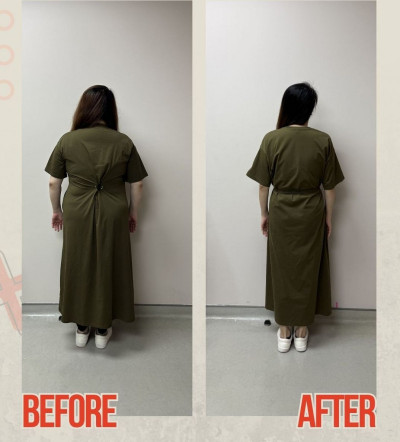 38歲師1年減重32公斤狂掉髮 醫提醒：瘦身別把營養也瘦掉